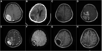 Case report: Diagnosis and treatment of delayed epidural pyogenic abscess after brain tumor operation: a report of 5 cases and review of the literature